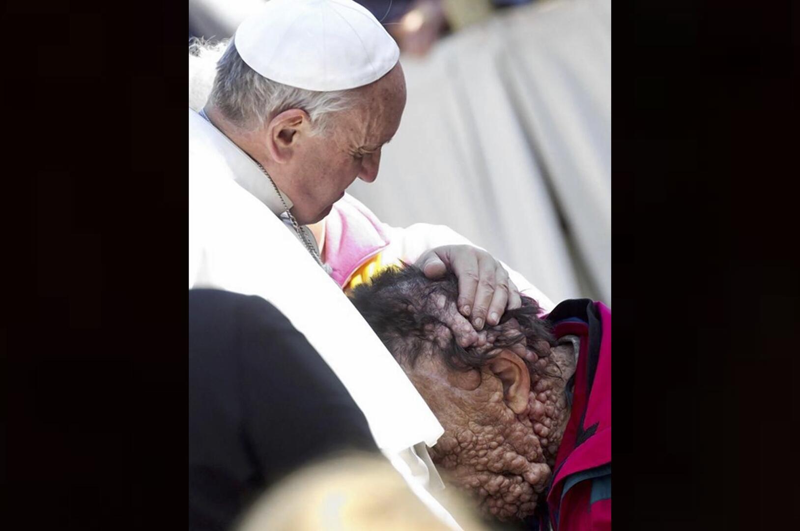 Pope Francis embraces a man with a skin condition