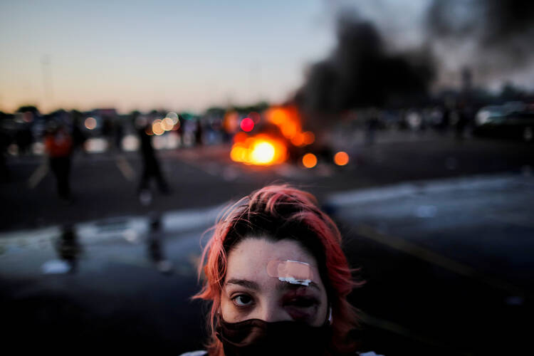 achel Perez of Minneapolis is pictured May 28, 2020, with injuries sustained from rubber bullets during protests while standing a distance from a burning vehicle at the parking lot of a Target store. (CNS photo/Carlos Barria, Reuters)