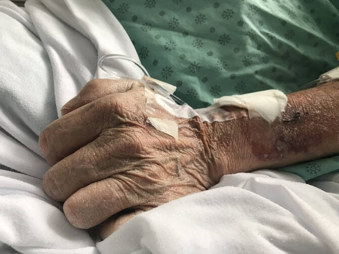 A close-up pf an elderly person's hand with an IV line attached