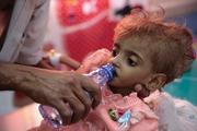 A father gives water to his severely malnourished daughter at a feeding center in Hodeida, Yemen, in September 2018. (AP Photo/Hani Mohammed, File)